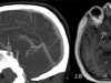 Quand du tissu thyroïdien se trouve à la base du crâne, dans l’iris ou dans l’ovaire